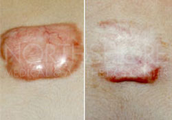 Scar & keloid Treatments