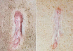 Scar & keloid Treatments