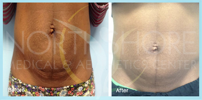 Radio Frequency Skin Tightening Result