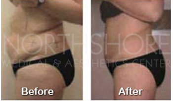 Utrasound Slimming
