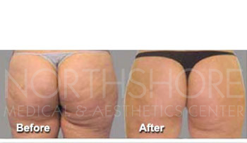 Utrasound Slimming