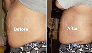 Utrasound Slimming