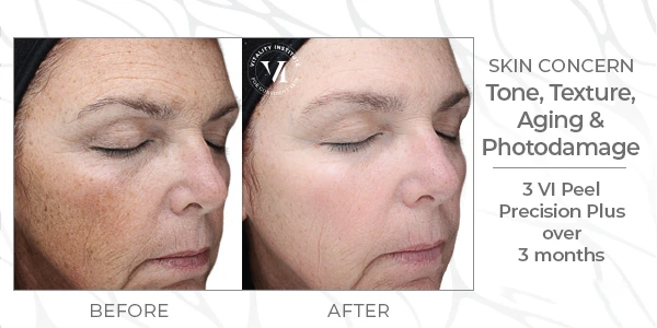vipeel